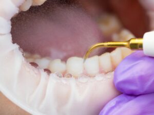 odstranjevanje zobnega kamna pri zobozdravniku